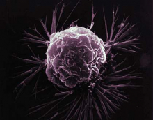 Closeup image of a breast cancer cell. (Photo courtesy National Cancer Institute) Closeup image of a breast cancer cell. (Photo courtesy National Cancer Institute)