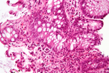 A high magnification micrograph of "cryptitis" in a case of Crohn's disease, colorized with an H&E stain and enhanced with post-processing. (Courtesy Wikimedia author Nephron) A high magnification micrograph of "cryptitis" in a case of Crohn's disease, colorized with an H&E stain and enhanced with post-processing. (Courtesy Wikimedia author Nephron)